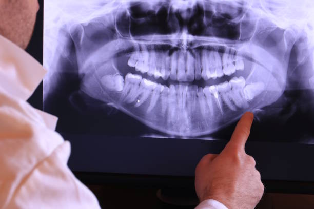 Best Knocked-Out Tooth (Avulsed Tooth) Treatment in Brook Highland, AL